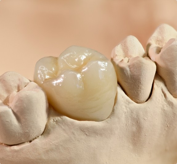 Dental crown over a tooth in a model of the mouth